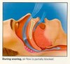 want to stop snoring